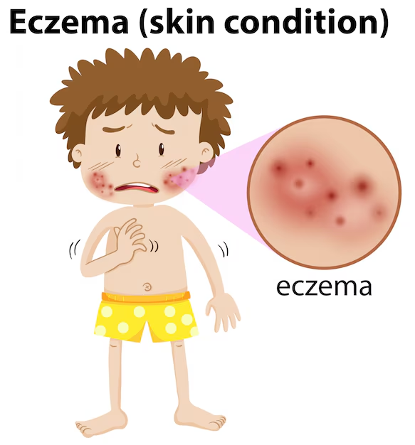 Natural Solutions for Eczema and Psoriasis in Ayurveda