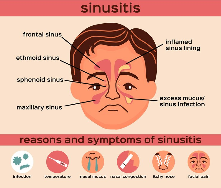 Managing Sinusitis with Ayurvedic Herbs