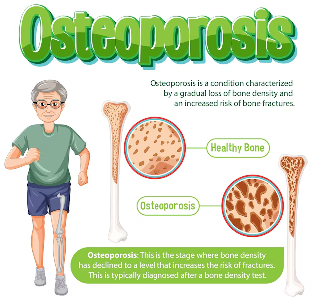 Managing Osteoporosis with Ayurvedic Herbs: A Natural Approach to Bone Health