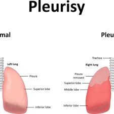 Understanding Pleurisy and Ayurvedic Approaches for Management