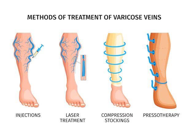 Dietary Adjustments to Prevent Varicose Veins