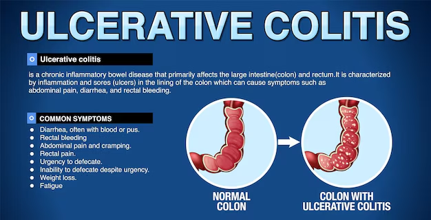 Navigating Chronic Challenges: Approaches to Managing Crohn’s Disease and Ulcerative Colitis