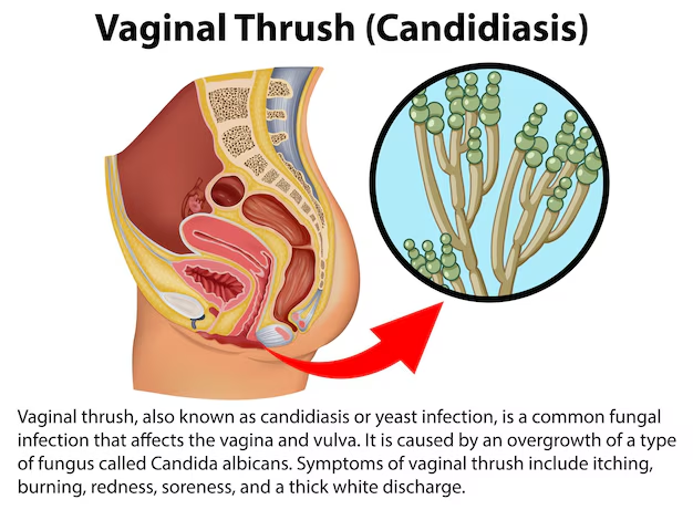 Ayurvedic Treatment for Candida Infection: A Comprehensive Guide